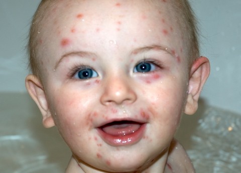 Causes of Smallpox in Babies | Smallpox Symptoms ...