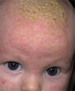 Cradle Cap in Infant...