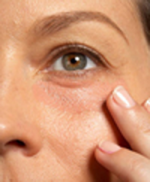 Dark circles and rem...