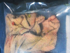 cloth in woman stomach in bangalore