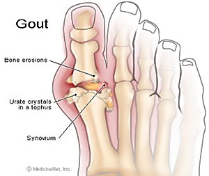 gout pain relief