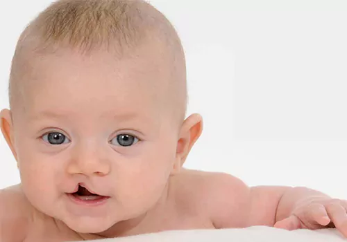 Birth defects in children