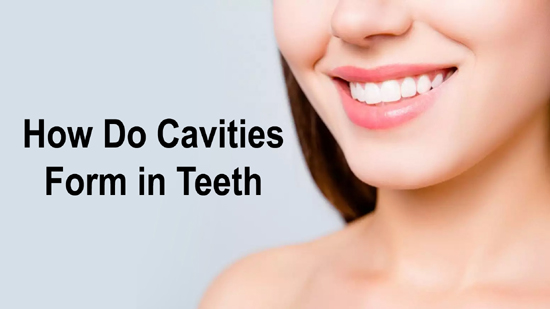 How Do Cavities Form in Teeth