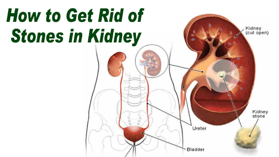 How to Get rid of Stones in Kidney