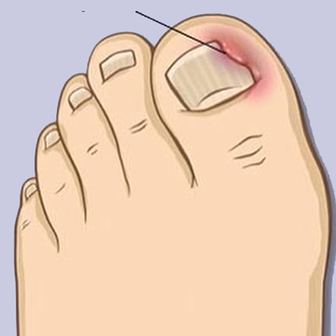 Painful Ingrown Nails!!