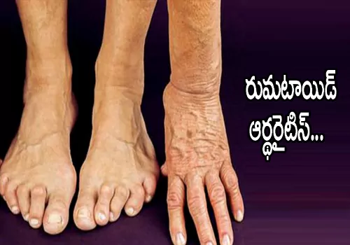 Rheumatoid arthritis alternative therapies