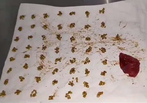 stones in woman stomach