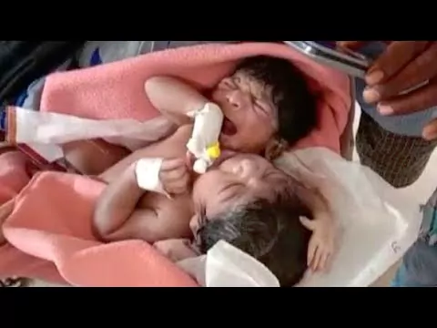 ఒడిశాలో రెండు తలల శిశువు జననం: వీణా వాణీలను గుర్తు తెస్తున్న వైనం.!