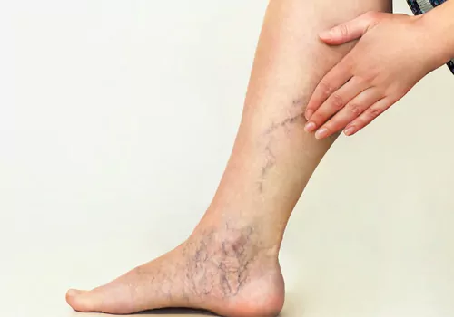 Varicose Veins Treatment