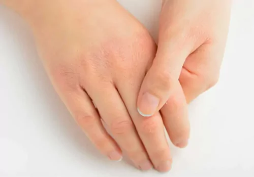 Vitamin A Toxicity
