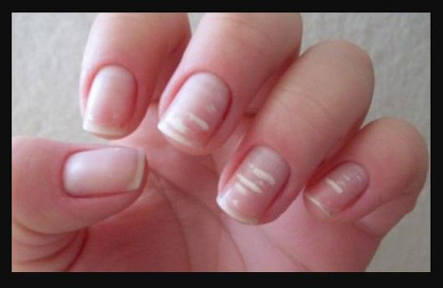 Ever wondered about the tiny white spots over nails