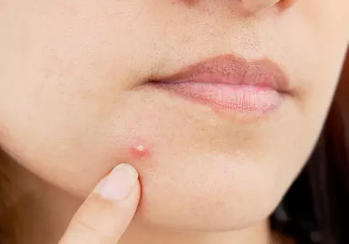 symptoms of iron deficiency