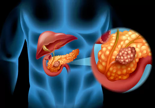 Pancreatic Cancer Can Be Detected