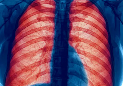 Chronic Obstructive Pulmonary Disease
