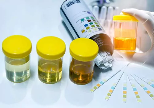 urine examination can detect alzheimers primary stage