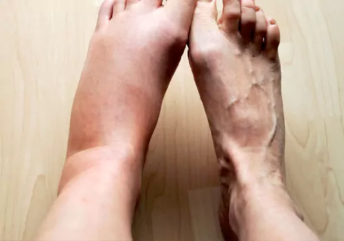 Inflammation is killing you Slowly