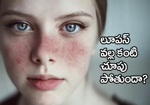 lupus may affect your eyes blind