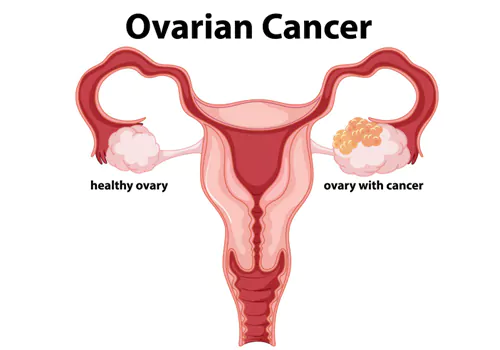 Are you at risk of ovarian cancer
