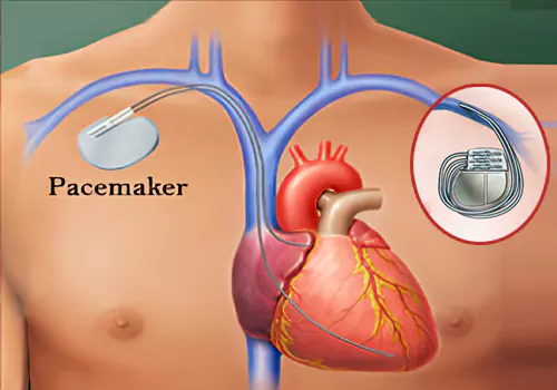 heartbeat can adjust with pacemakers