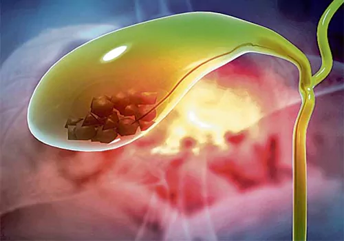 పిత్తాశయంలో రాళ్లు ఎందుకు వస్తాయో తెలుసా?
