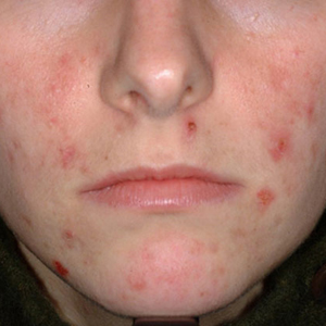 indore girl suicide pimples face suicide poison