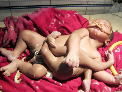 god baby born in west bengal state eight limbs baby 